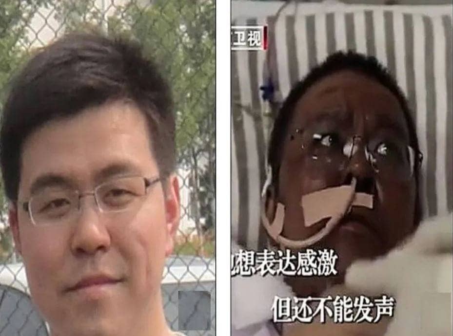 कोरोना से बदल गया था दो डॉक्टरों के चेहरे का रंग, अब हो रहा सुधार