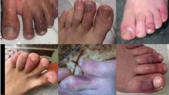 स्किन पर भी पड़ रहा कोरोना का बुरा असर, शरीर पर दिखे ऐसे धब्बे!