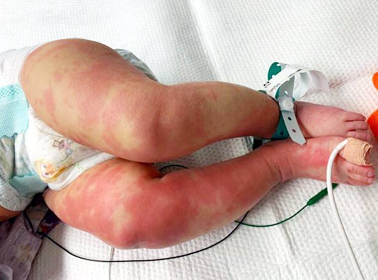 रहस्यमय सिंड्रोम से US में बच्चों की मौतें, क्या इसका कोरोना कनेक्शन है?