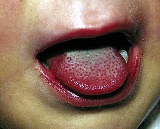 रहस्यमय सिंड्रोम से US में बच्चों की मौतें, क्या इसका कोरोना कनेक्शन है?