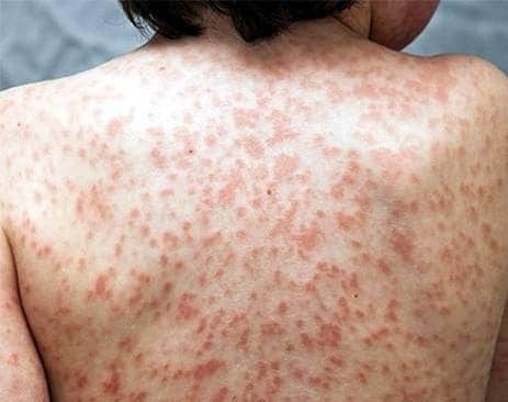 रहस्यमय सिंड्रोम से US में बच्चों की मौतें, क्या इसका कोरोना कनेक्शन है?