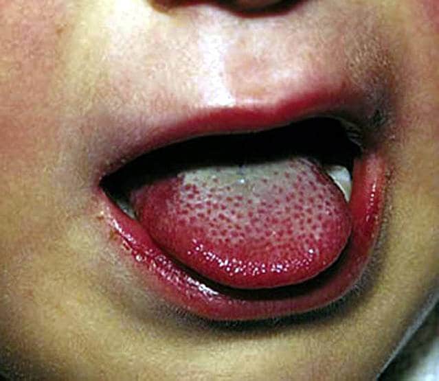 कोरोना से जुड़ी रहस्यमयी बीमारी से बच्चे की मौत, परेशान है अमेरिकी सरकार