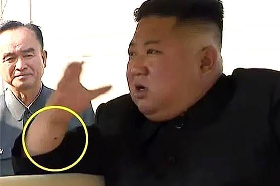 20 दिन बाद सामने आए किम जोंग के शरीर पर रहस्यमय निशान, डॉक्टरों ने कही ये बात