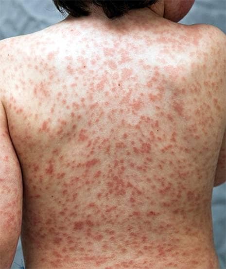 कोरोना से जुड़ी रहस्यमयी बीमारी से बच्चे की मौत, परेशान है अमेरिकी सरकार