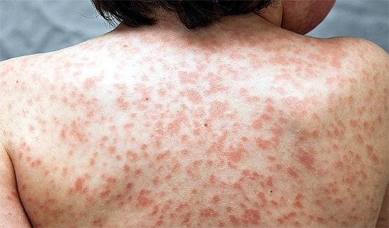 भारत पहुंच गई कोरोना से जुड़ी दुर्लभ बीमारी, यहां मिला पहला केस