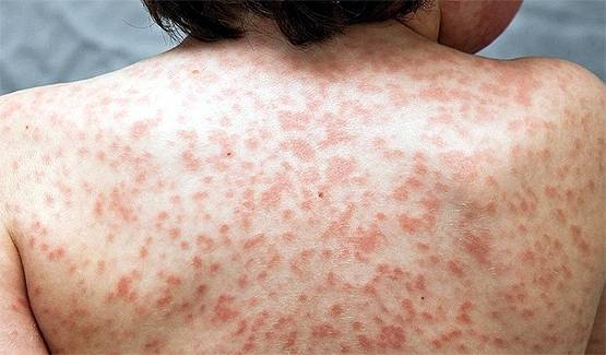 भारत आई कोरोना से जुड़ी बच्चों की दुर्लभ बीमारी, ये लक्षण न करें इग्नोर!