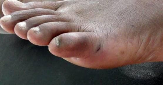 कोबरा ने इंसान को काटा, सांप की मौत लेकिन जिंदा रहा शख्स