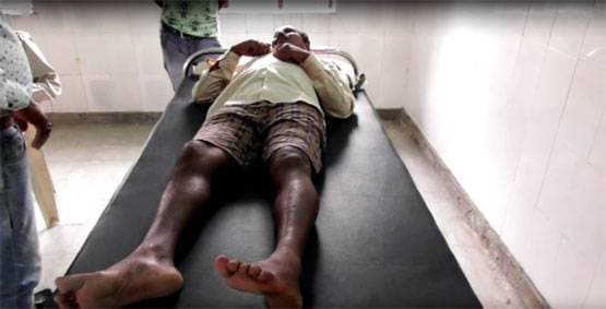 कोबरा ने इंसान को काटा, सांप की मौत लेकिन जिंदा रहा शख्स