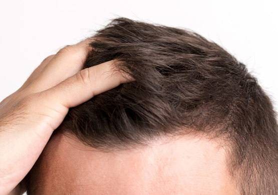 झड़ते बालों से हैं परेशान तो अपनी डाइट में शामिल करें ये तीन चीजें