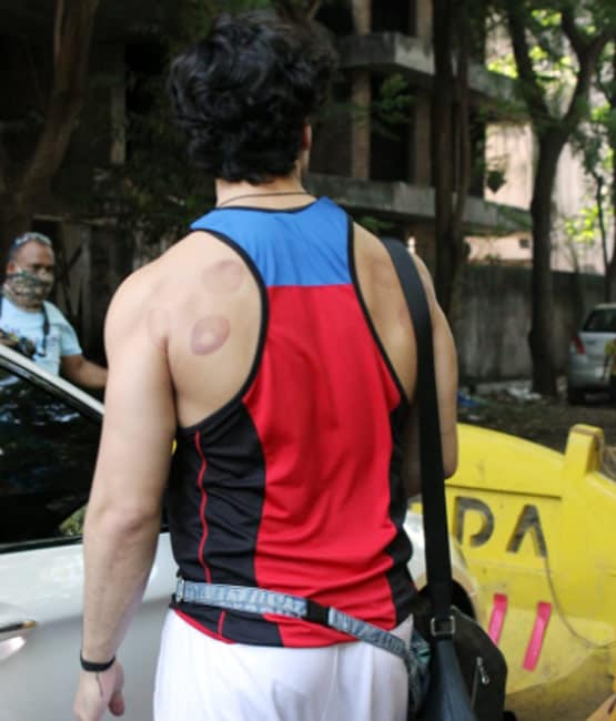 टाइगर श्रॉफ की पीठ पर ये कैसे निशान, क्या एक्टर ने कराई कपिंग थेरेपी?