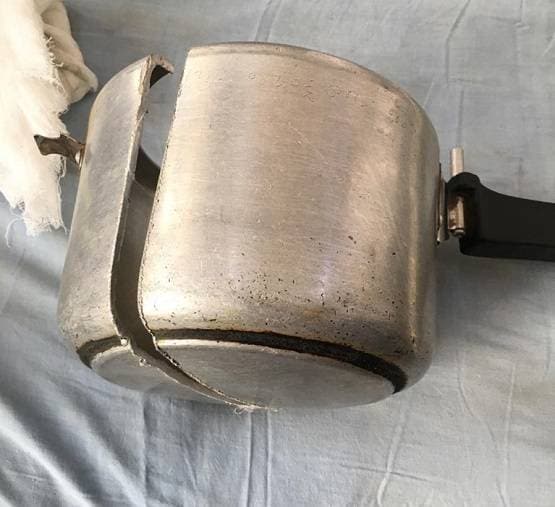 कुकर में फंस गया मासूम का सिर, डॉक्टर भी हुए फेल तो ऐसे निकाला