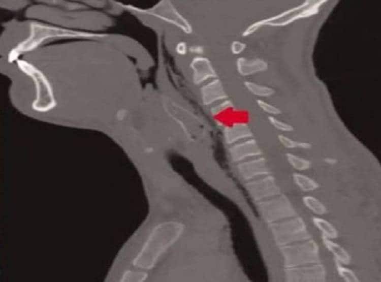 जिंदा मछली मुंह में डालकर बनाया वीडियो, गले में अटकने से हुई मौत