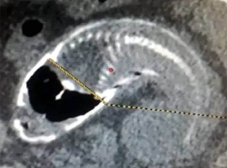चीन में शख्स के मलाशय से पेट तक चली गई मछली, डॉक्टर भी हो गए हैरान