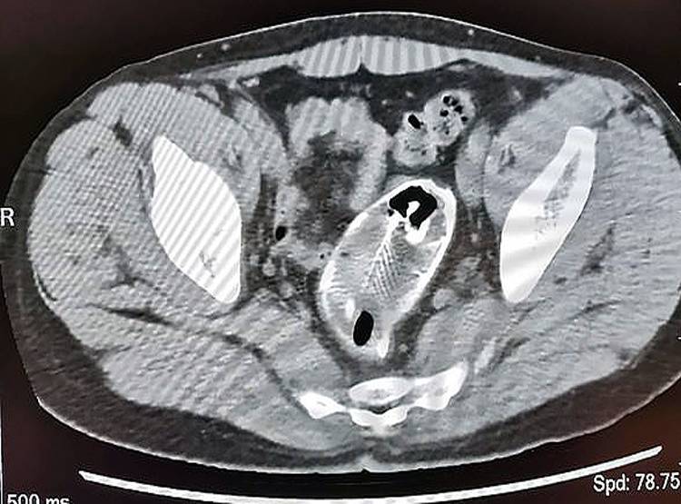चीन में शख्स के मलाशय से पेट तक चली गई मछली, डॉक्टर भी हो गए हैरान