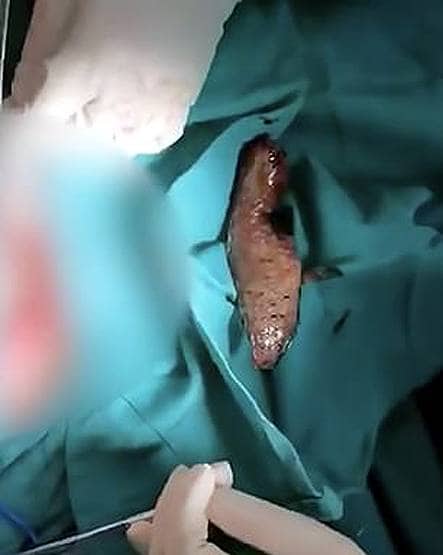 चीन में शख्स के मलाशय से पेट तक चली गई मछली, डॉक्टर भी हो गए हैरान