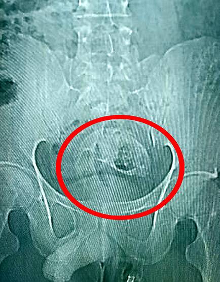 चीन में शख्स के मलाशय से पेट तक चली गई मछली, डॉक्टर भी हो गए हैरान