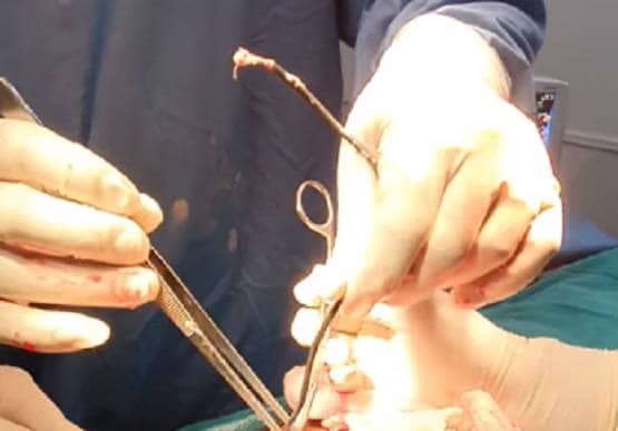 ऑपरेशन के दौरान पेट से निकला हेडफोन केबल, डॉक्टर भी रह गए हैरान