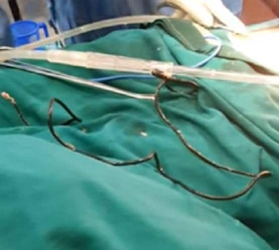ऑपरेशन के दौरान पेट से निकला हेडफोन केबल, डॉक्टर भी रह गए हैरान