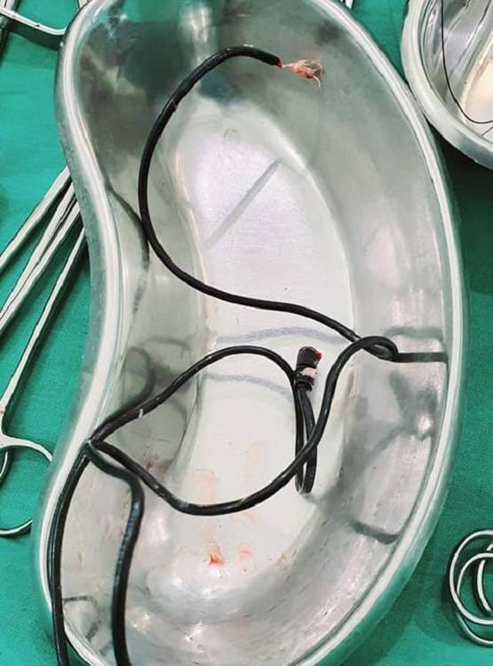 ऑपरेशन के दौरान पेट से निकला हेडफोन केबल, डॉक्टर भी रह गए हैरान