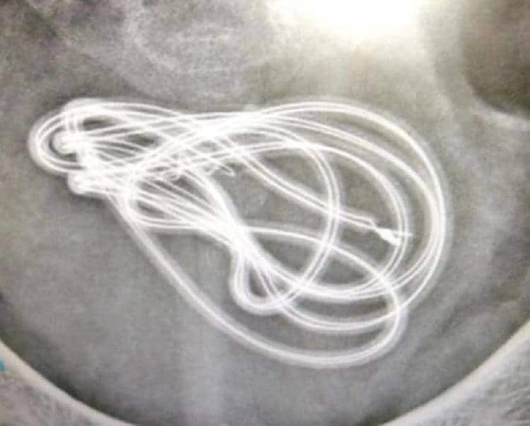 ऑपरेशन के दौरान पेट से निकला हेडफोन केबल, डॉक्टर भी रह गए हैरान