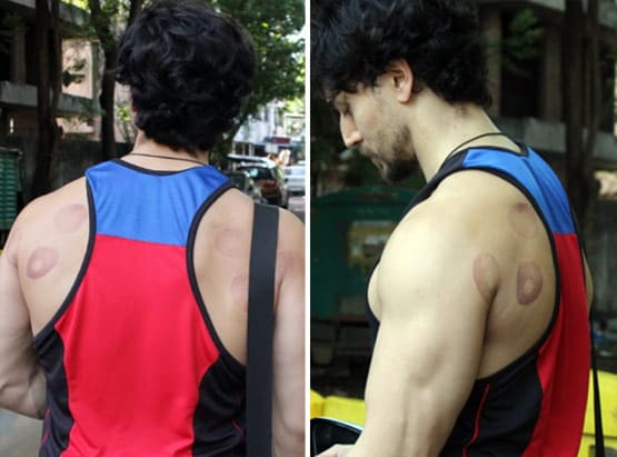 टाइगर श्रॉफ की पीठ पर ये कैसे निशान, क्या एक्टर ने कराई कपिंग थेरेपी?