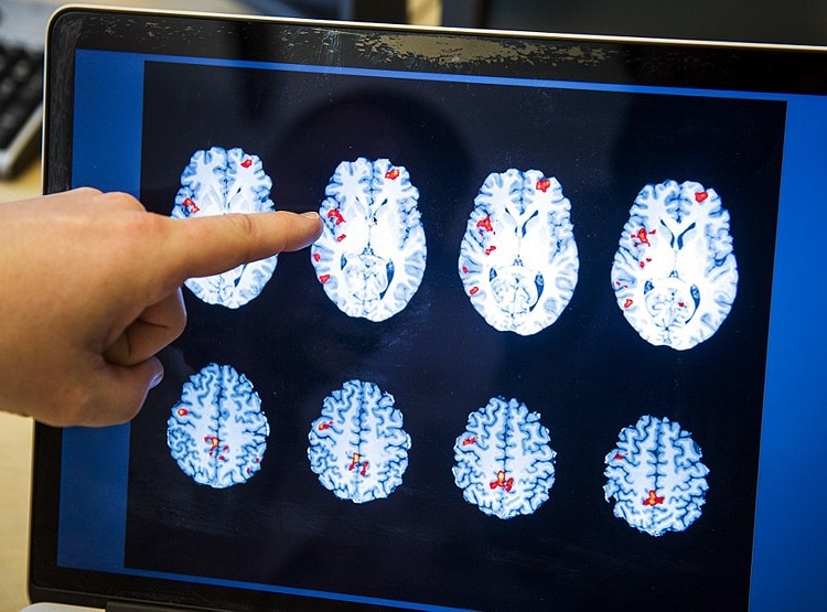 स्टडी में दावाः कोरोना मरीजों के दिमाग पर हो रहे ये खतरनाक नुकसान