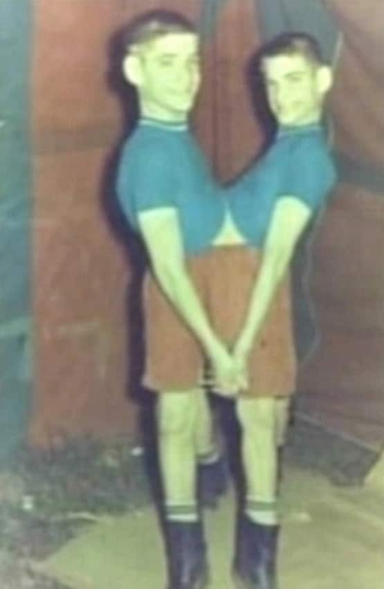 पेट से जुड़े भाइयों की मौत, दुनिया में सबसे ज्यादा जीने का था रिकॉर्ड