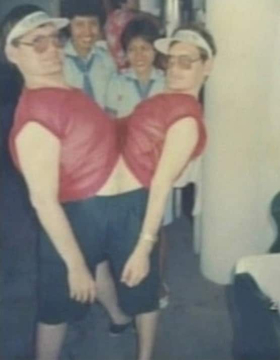 पेट से जुड़े भाइयों की मौत, दुनिया में सबसे ज्यादा जीने का था रिकॉर्ड