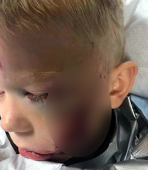 हीरो: 6 साल के बच्चे ने बहन को कुत्ते से बचाया, चेहरे पर आए 90 टांकें