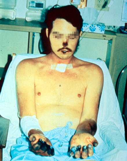 चीन में 'ब्यूबोनिक प्लेग' का खतरा! इसे 'काली मौत' भी कहते हैं