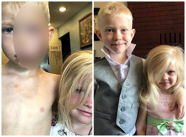 हीरो: 6 साल के बच्चे ने बहन को कुत्ते से बचाया, चेहरे पर आए 90 टांकें