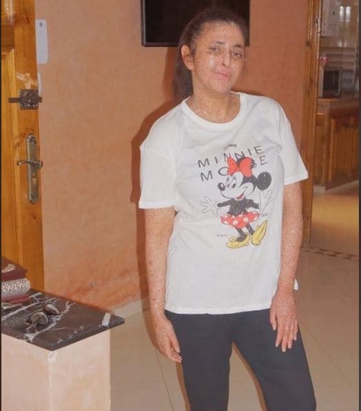 इस महिला को अजीब बीमारी, 20 साल से पहन रही हेलमेट, धूप ले सकती है जान