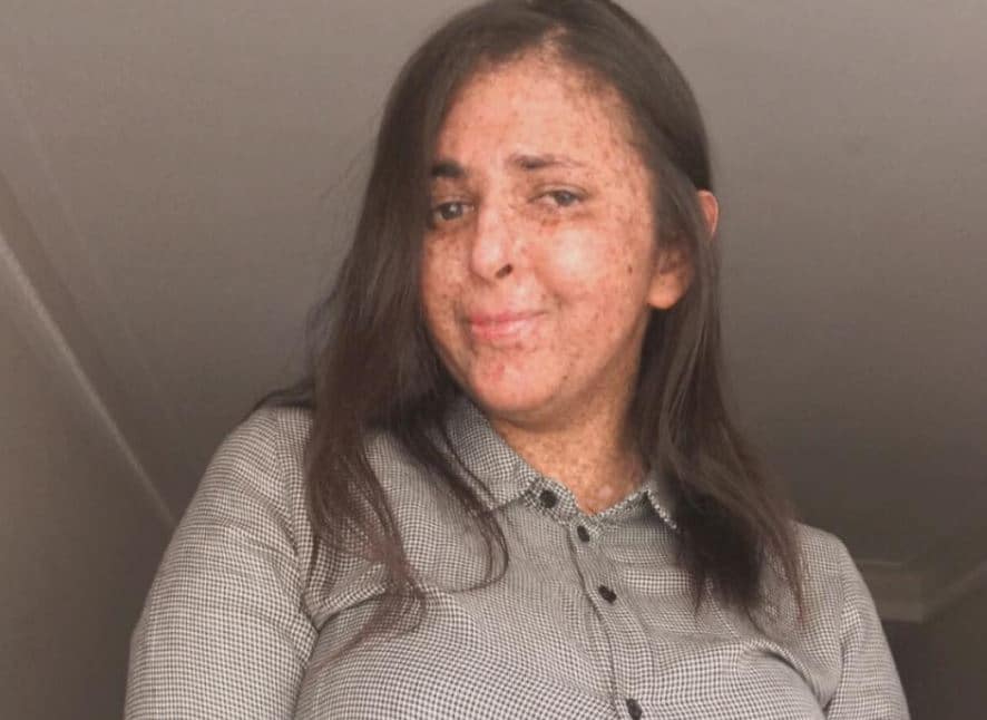 इस महिला को अजीब बीमारी, 20 साल से पहन रही हेलमेट, धूप ले सकती है जान