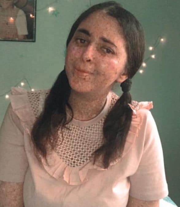 इस महिला को अजीब बीमारी, 20 साल से पहन रही हेलमेट, धूप ले सकती है जान