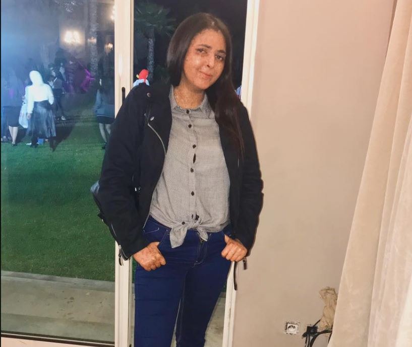 इस महिला को अजीब बीमारी, 20 साल से पहन रही हेलमेट, धूप ले सकती है जान