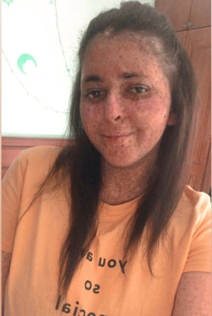 इस महिला को अजीब बीमारी, 20 साल से पहन रही हेलमेट, धूप ले सकती है जान