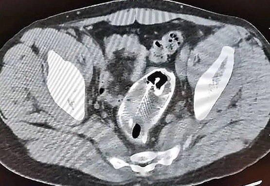 अधपकी मछली खाना शख्स को पड़ा भारी, लीवर में इल्ली ने दे दिए अंडे