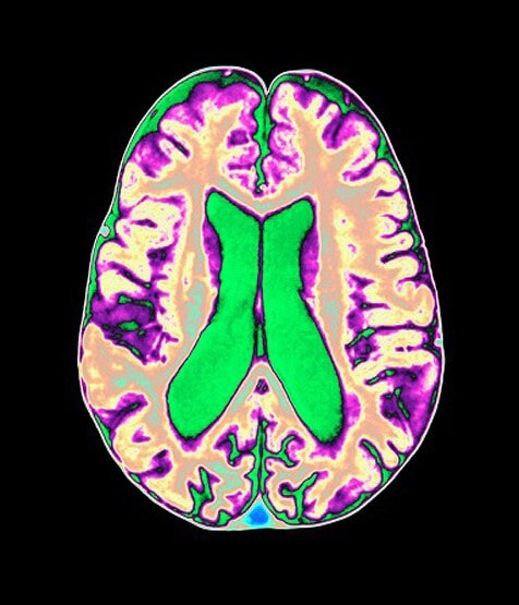 स्टडी में दावाः कोरोना मरीजों के दिमाग पर हो रहे ये खतरनाक नुकसान