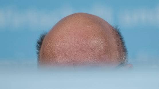 वैज्ञानिकों की चेतावनी- गंजे लोगों को हो सकता है कोरोना से अधिक खतरा