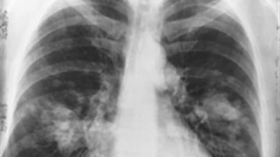 फेफड़े ही नहीं, किडनी, लीवर, हार्ट, ब्रेन, स्किन पर भी हमला करता है कोरोना