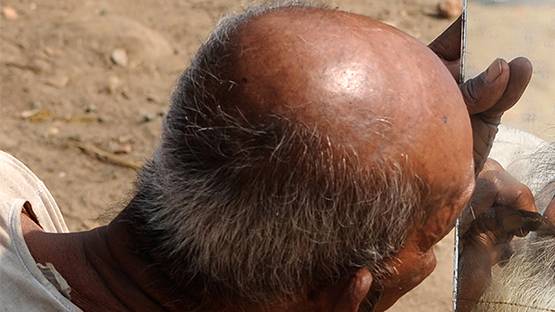 वैज्ञानिकों की चेतावनी- गंजे लोगों को हो सकता है कोरोना से अधिक खतरा