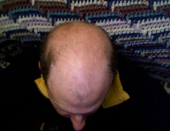 गंजेपन के शिकार लोगों के लिए घातक कोरोना, स्टडी में खुलासा