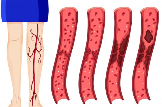 ब्रेन स्ट्रोक हो सकता है जानलेवा, ये लक्षण दिखें तो हो जाएं सावधान