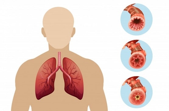 इन 6 कारणों से किसी को भी हो सकता है फेफड़ों का कैंसर, जानें लक्षण और बचाव