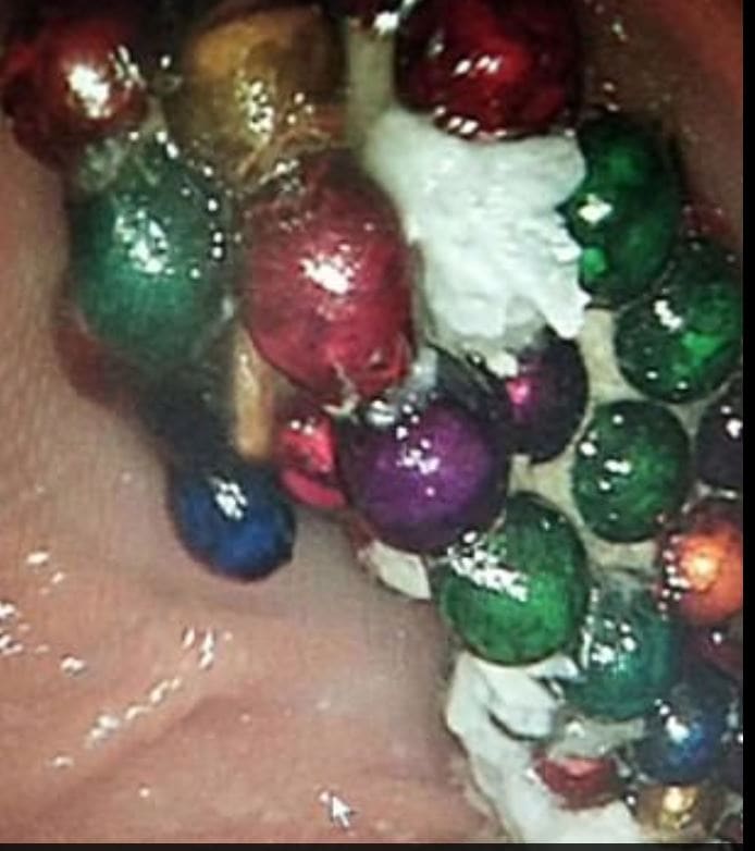 जब बच्ची के पेट में मिले 190 मैग्नेटिक बॉल, डॉक्टर भी रह गए दंग