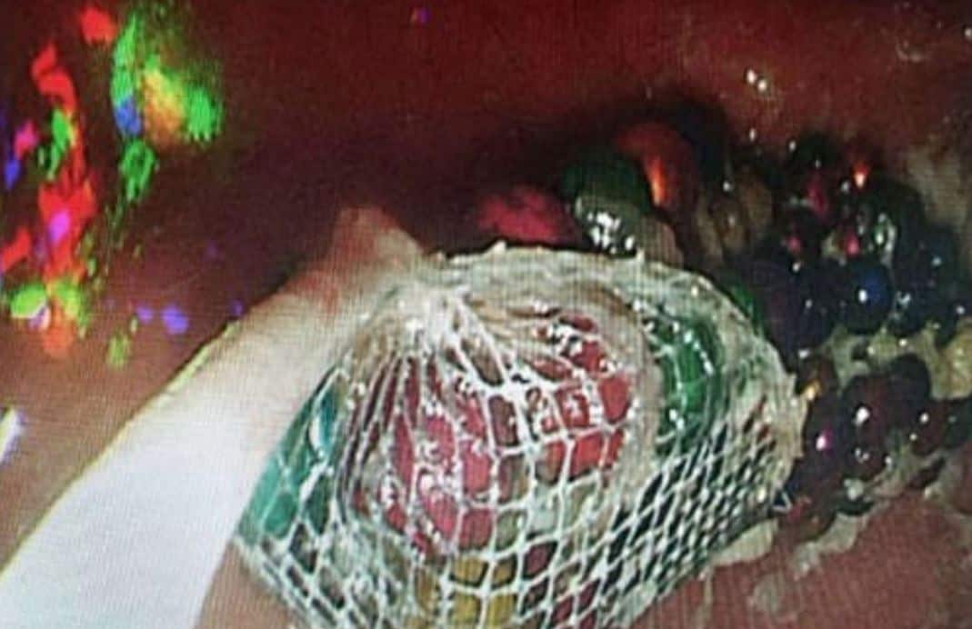 जब बच्ची के पेट में मिले 190 मैग्नेटिक बॉल, डॉक्टर भी रह गए दंग