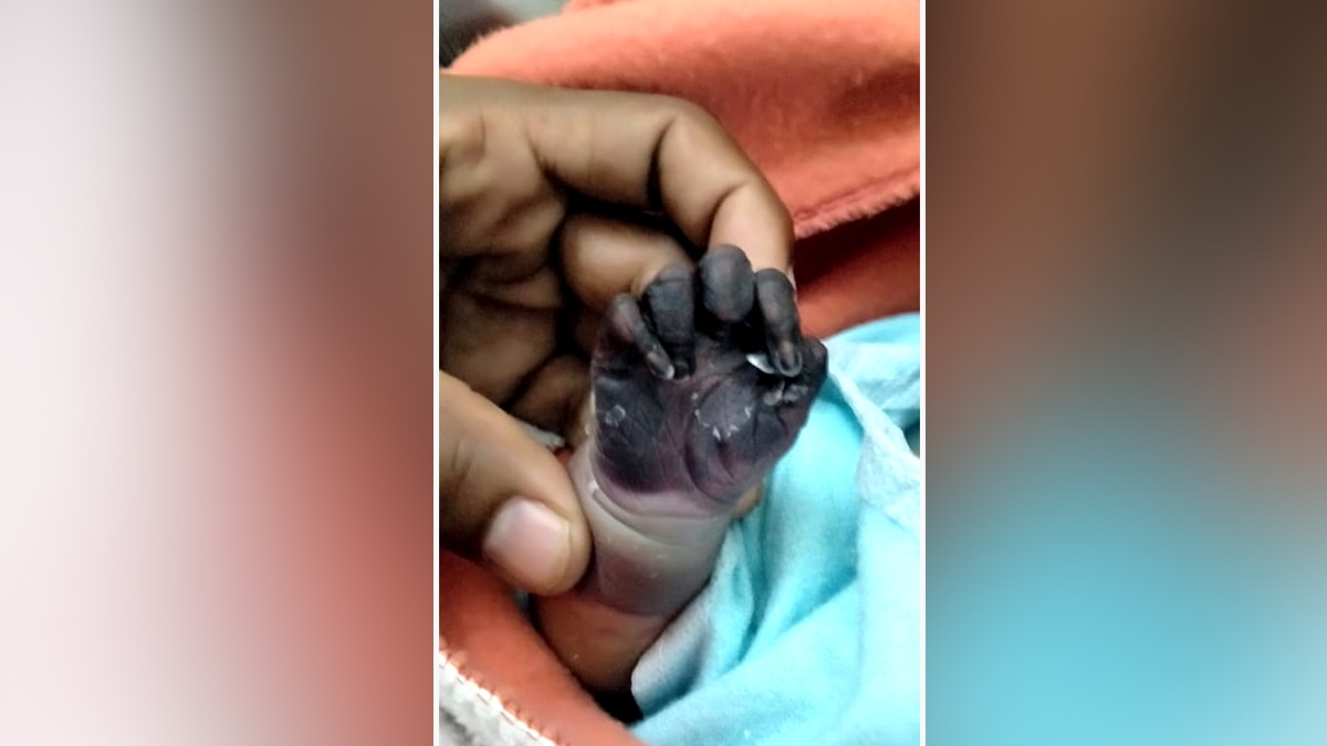  काला पड़ा बच्चे का हाथ. 