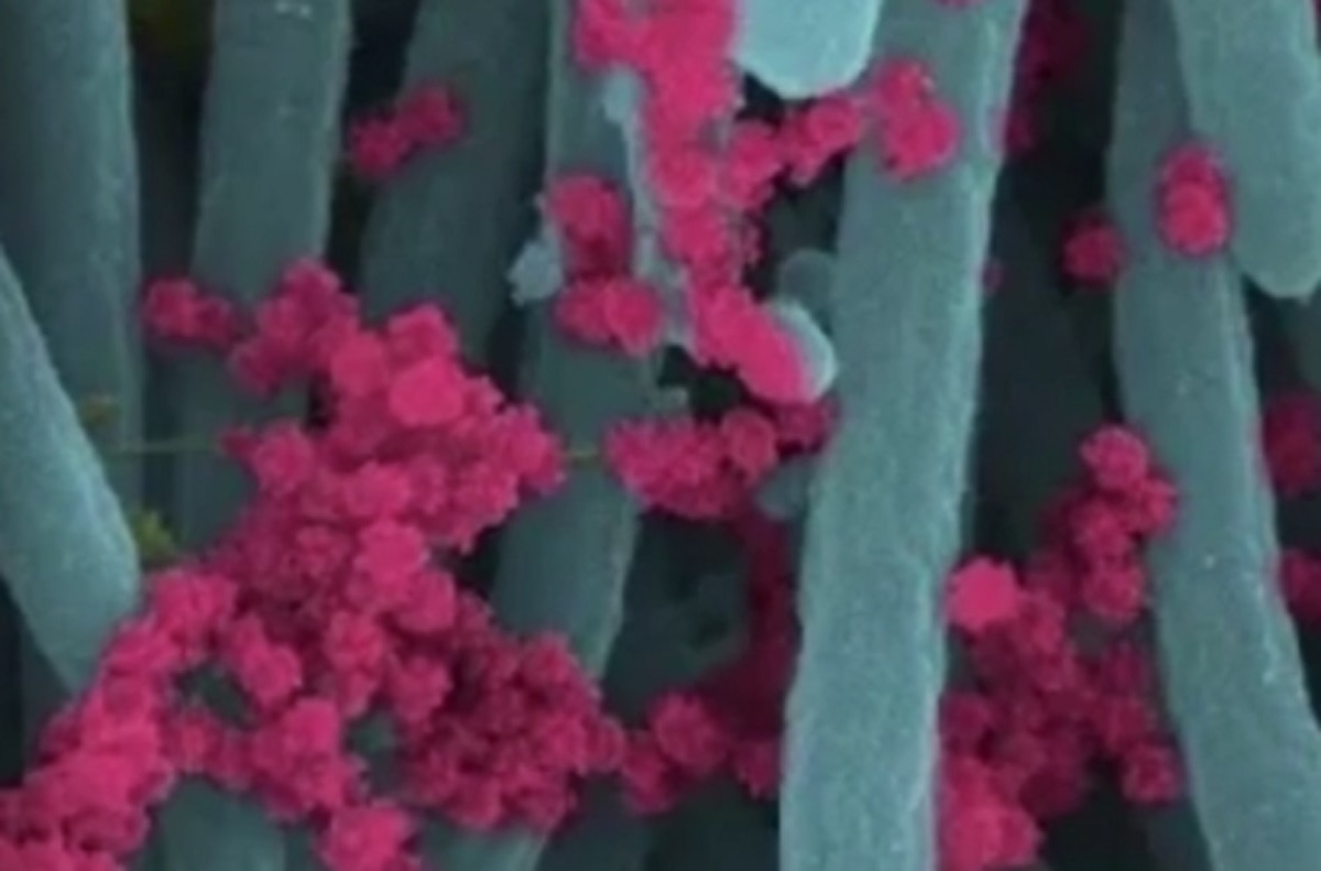 कोरोना से संक्रमित कोशिकाओं की तस्वीरें सामने आईं