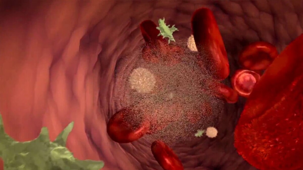 ब्लड कैंसर. 