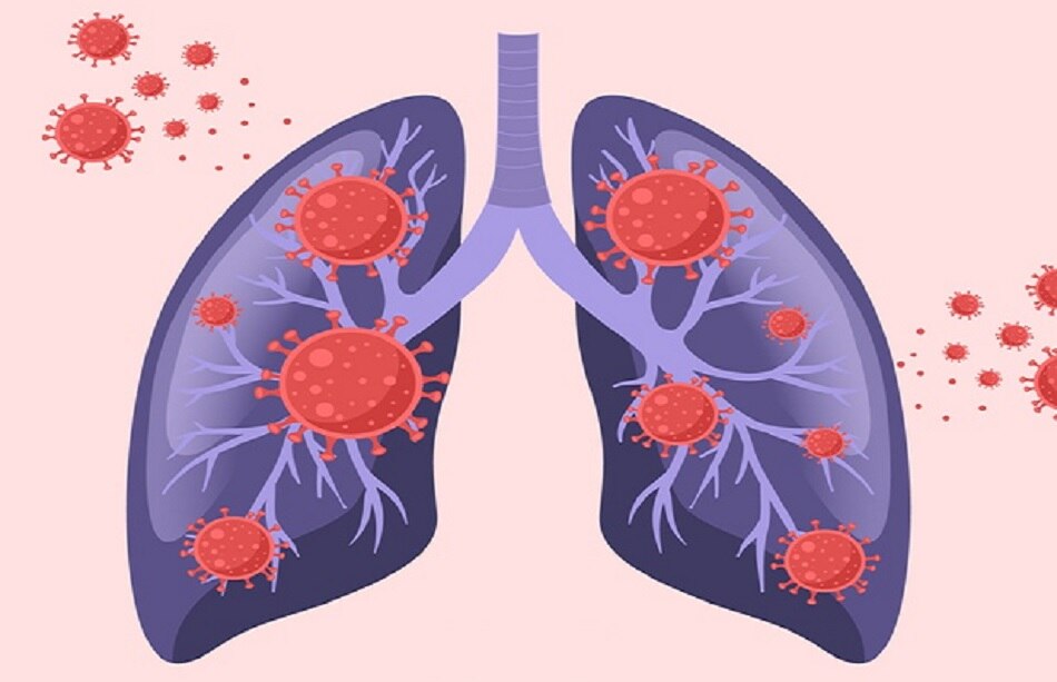 पल्मोनरी फाइब्रोसिस के कारण